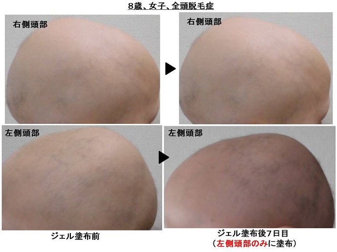 円形脱毛症　病院""